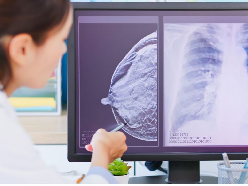 Imagerie médicale - Mammographie Imagerie médicale - Mammographie