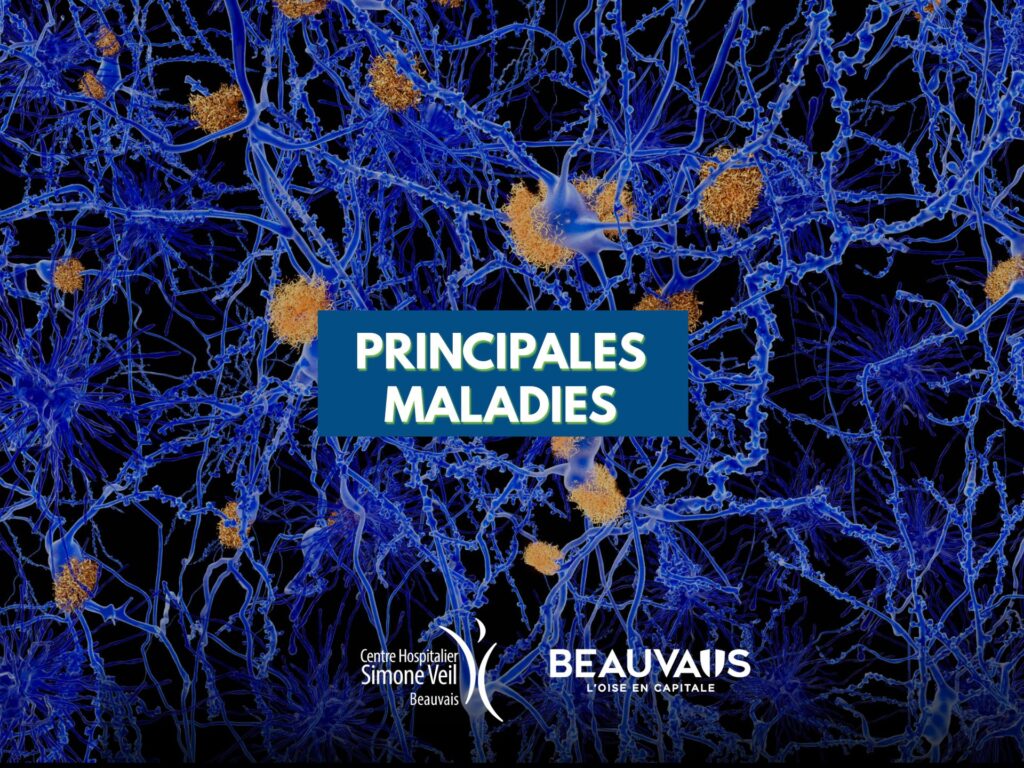 maladies neurodégénératives neurologie neurone cerveau parkinson alzheimer rdv sante (5)
